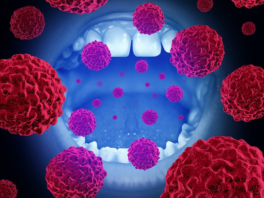Detecting Oral Cancer: What You Need to Know
