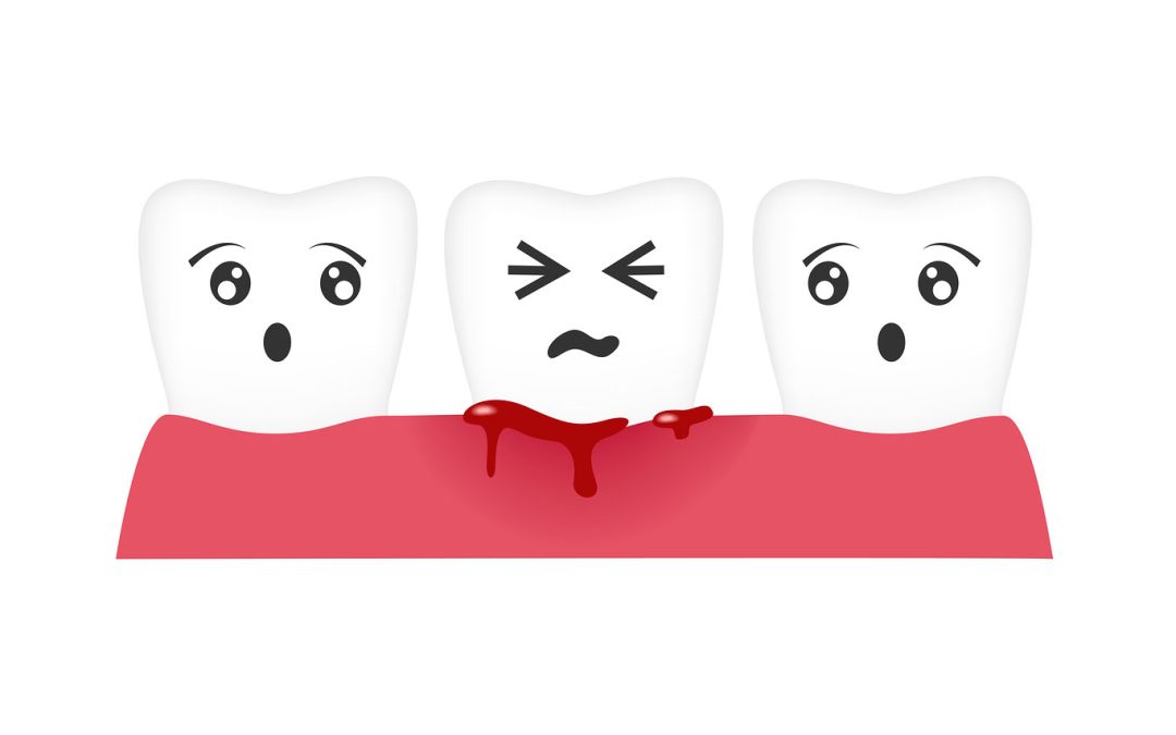What is Gingivitis and How do I Treat It?