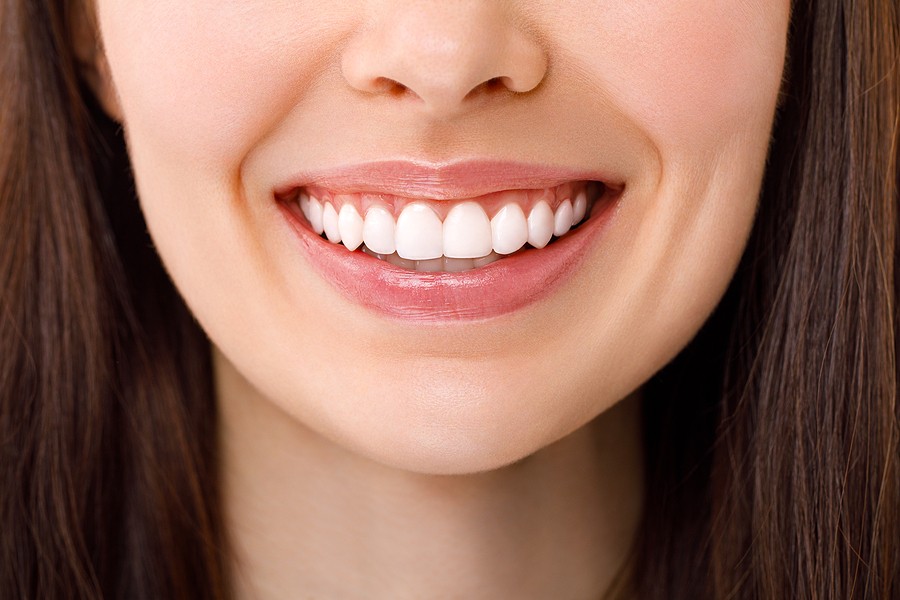 A woman smiling showing teeth considering veneers.